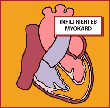 Medizinische Illustration eines Herzens mit infiltriertem Myokard