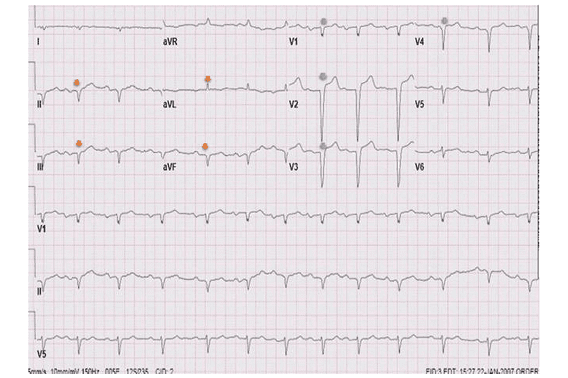 EKG‑Ableitung mit Niedervoltage‑Mustern und Leitungsstörungen über mehrere Ableitungen